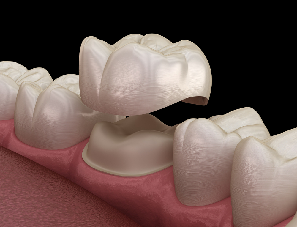 Different Types of Dental Crowns Available in Dubai Dr Joy Dental Clinic
