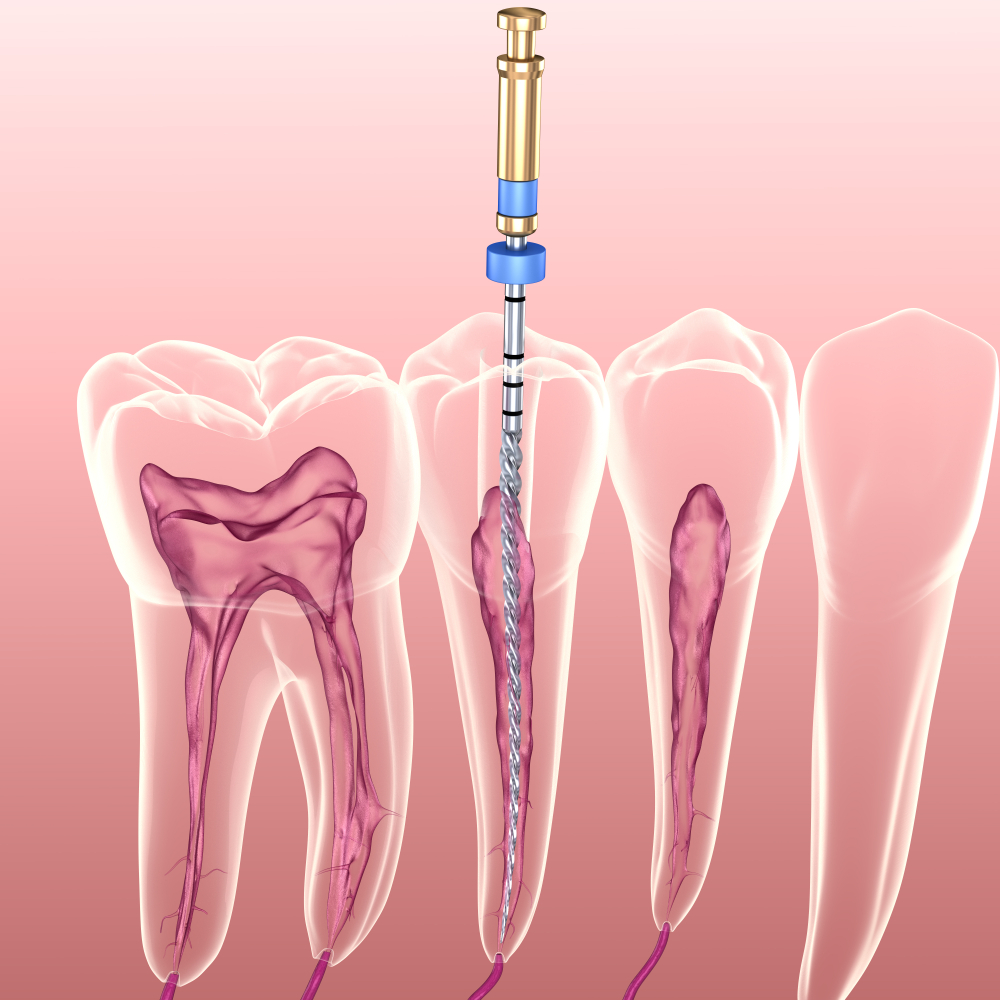What is a Root Canal Treatment? Dr Joy Dental Clinic