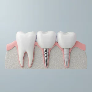 Dental implants