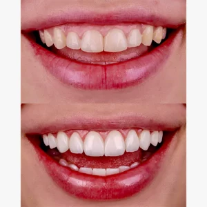 Aesthetic gum correction