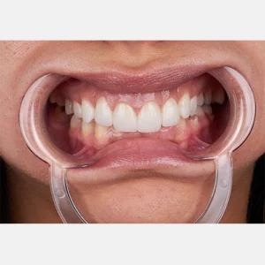 Gum depigmentation