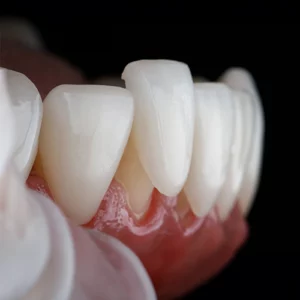  Porcelain veneers