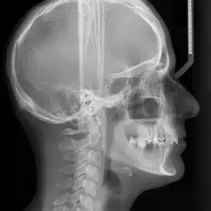 Cephalometric analysis
