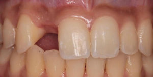 Before Treatment Photo