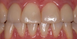 After Treatment Photo