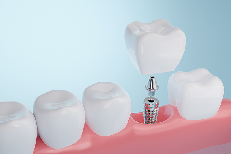 img-single-tooth