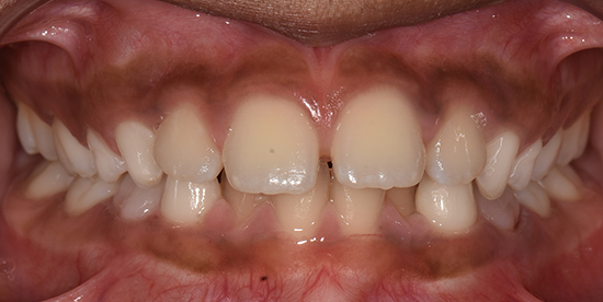 Before
