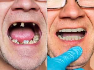 10 Indicators You Want to Go through a Complete Mouth Rehabilitation