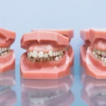 malloclusions