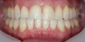 After Treatment Photo