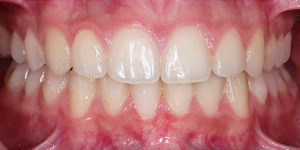 After Treatment Photo