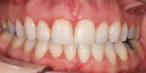 After Treatment Photo