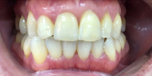 Before Treatment Photo