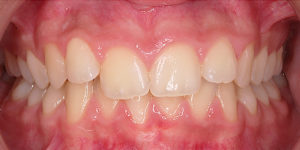 Before Treatment Photo