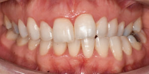 Before Treatment Photo