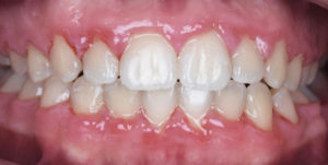 After Treatment Photo