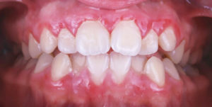 Before Treatment Photo