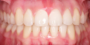 After Treatment Photo