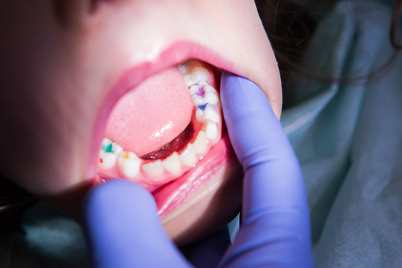 Importance of Dental Sealants for Kids