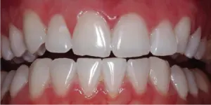 After Treatment Photo