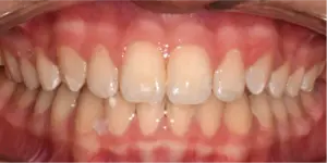 After Treatment Photo