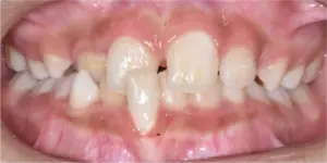 Before Treatment Photo