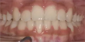 After Treatment Photo