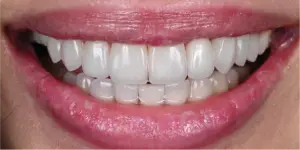 After Treatment Photo