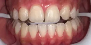 Before Treatment Photo