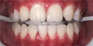 After Treatment Photo