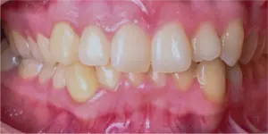 Before Treatment Photo