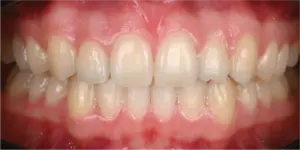 After Treatment Photo