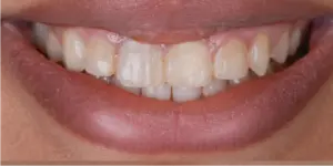 Before Treatment Photo