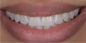 After Treatment Photo