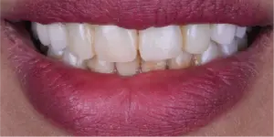 Before Treatment Photo