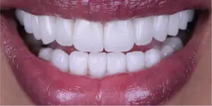After Treatment Photo