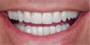 After Treatment Photo