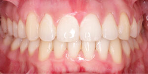 After Treatment Photo