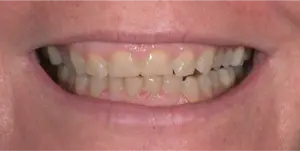 Before Treatment Photo