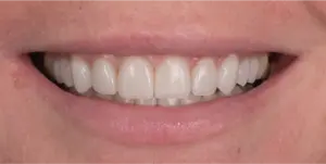 After Treatment Photo