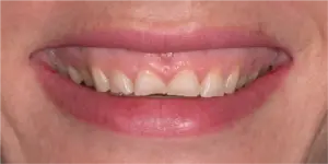 Before Treatment Photo