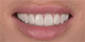 After Treatment Photo