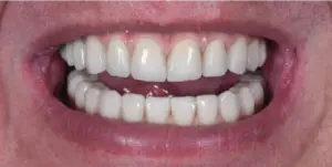 After Treatment Photo
