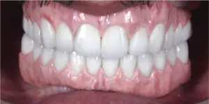 After Treatment Photo