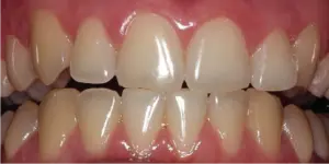 Before Treatment Photo