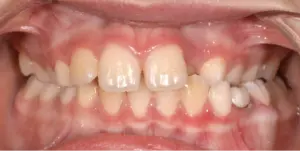 Before Treatment Photo