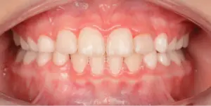 After Treatment Photo