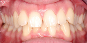 Before Treatment Photo