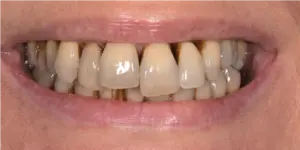 Before Treatment Photo