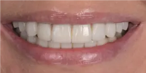 After Treatment Photo